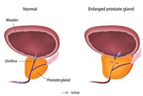 What IS an enlarged prostate? As it's revealed King Charles will have his treated in hospital ...