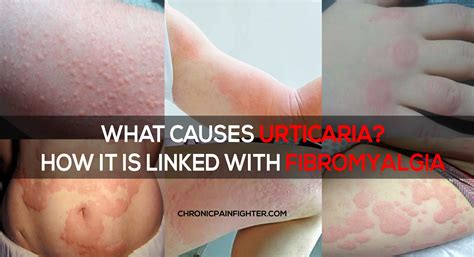 What Causes Urticaria? How It is Linked With Fibromyalgia