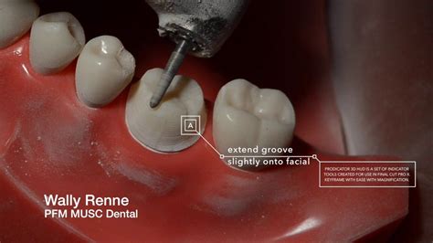 PFM Crown Prep and animation for Dental Students | Dental, Dental ...