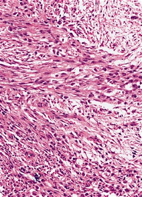 Pathology Outlines - Myositis ossificans