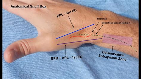 Live Surgery: De Quervain's Tenosynovitis: 1st Extensor Compartment ...