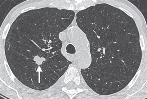 Solitary and Multiple Pulmonary Nodules | Radiology Key