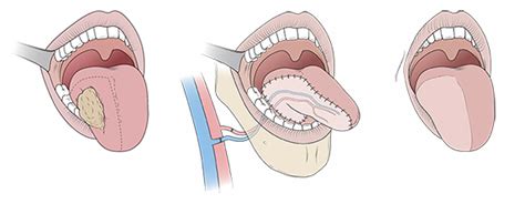 Tongue Surgery | UI Health