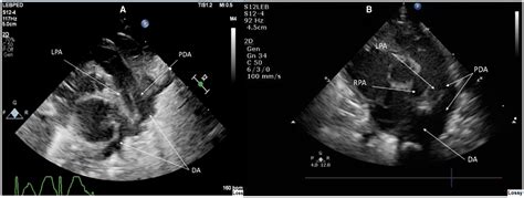 Echocardiography of the patent ductus arteriosus in premature infant - Paudel - 2019 ...