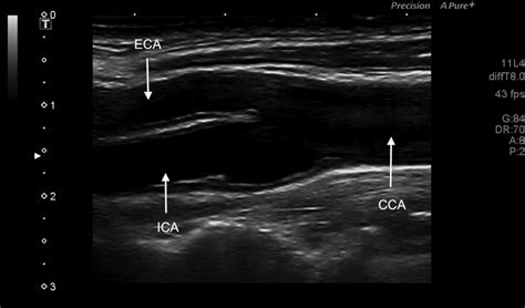 Technical recommendations for the use of carotid duplex ultrasound for the assessment of ...