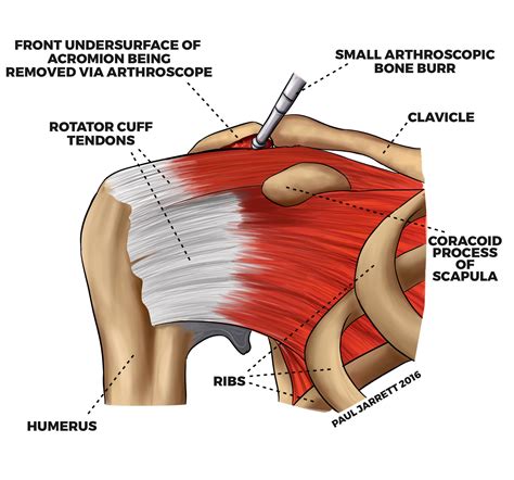 Impingement & Bursitis - Dr Paul Jarrett, Orthopaedic Surgeon Perth