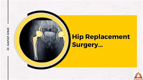 Hip Replacement Surgery [Hip Replacement Surgery Time]