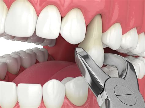 When is Tooth Extraction Recommended by General Dentists? - Draper ...