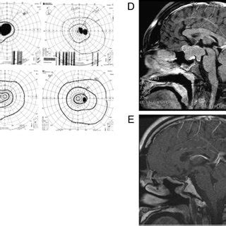 (A) Patient 5 years after surgery; Goldmann visual field test before... | Download Scientific ...