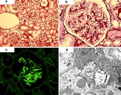 Kidney biopsy findings of case 1. a Light microscopic finding of kidney... | Download Scientific ...