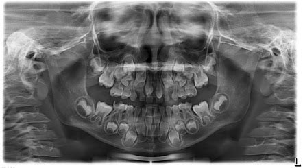Supernumerary teeth | Radiology Reference Article | Radiopaedia.org