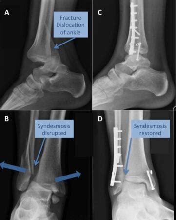 Harvey Elliott injury explained: Expert view on recovery and future performance - Liverpool FC ...