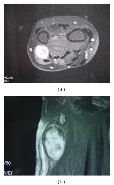 Schwannoma | Concise Medical Knowledge