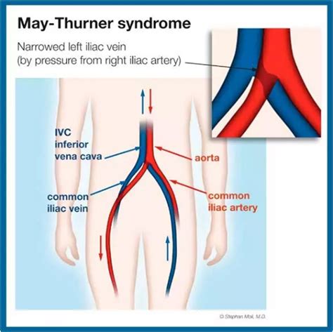 May Thurner Syndrome - New York Vein Treatment Center