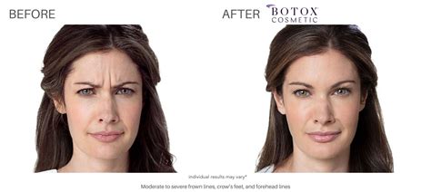 Botox Before and After | Real Patient Results in Chatham