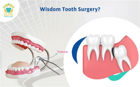 Is wisdom tooth removal a major surgery? | Elite Dental Care