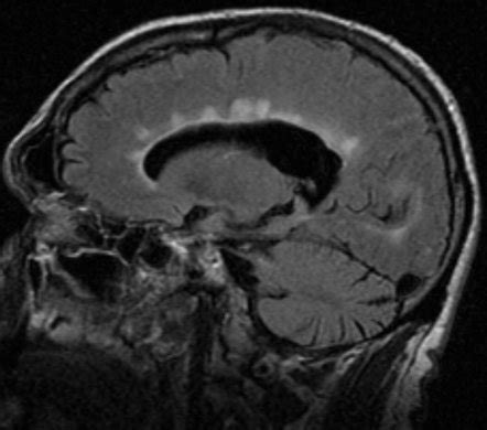 Multiple sclerosis | Radiology Reference Article | Radiopaedia.org