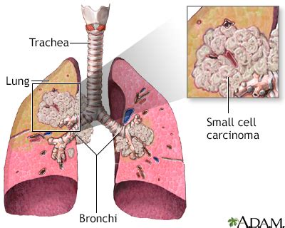 Lung cancer - small cell Information | Mount Sinai - New York