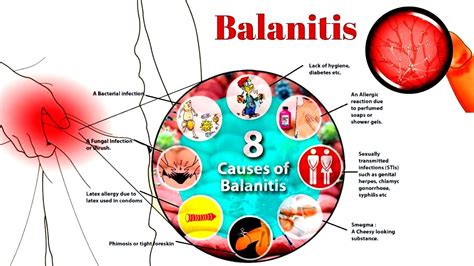 Sesión plenaria misericordia obesidad candida balanitis causes Hueso bancarrota idiota