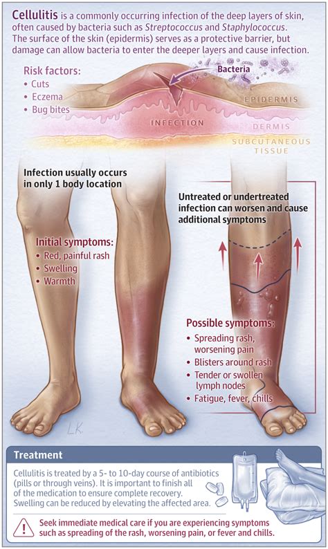 This Patient Page describes the symptoms, possible causes, and treatment of cellulitis ...