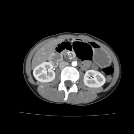 Midgut volvulus | Radiology Reference Article | Radiopaedia.org