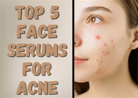 TOP 5 FACE SERUMS FOR ACNE