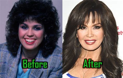 Marie Osmond Plastic Surgery: Facelift, Nose Job, Before-After! | CelebritySurgeryIcon