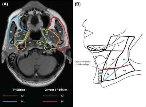 TNM Staging of Nasopharyngeal Carcinoma (AJCC 8) - ENT, Head & Neck