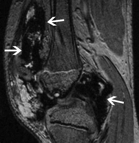 Pigmented Villonodular Synovitis: Radiologic-Pathologic Correlation | RadioGraphics