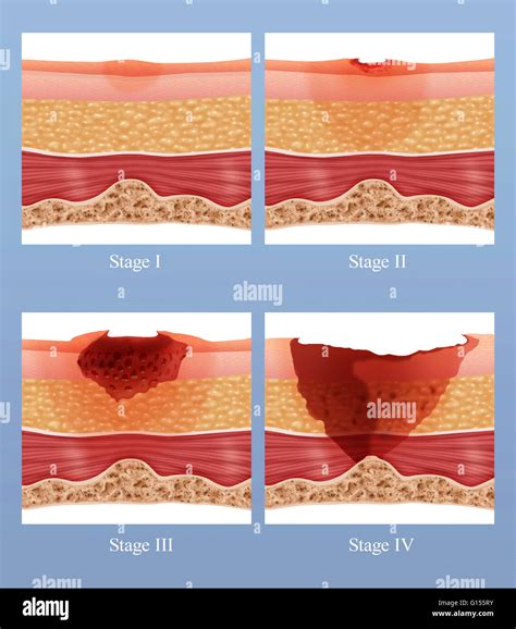 Pressure Ulcers Bed Sores Pressure Ulcer Bed Sores Pressure Ulcer ...