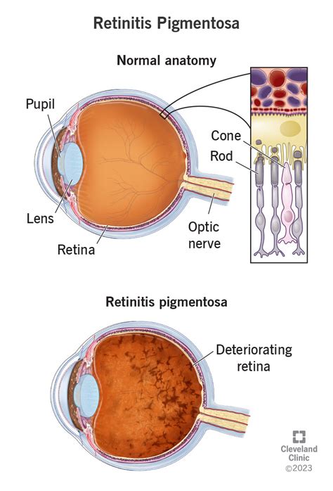 Retinitis Pigmentosa (RP): Diagnosis, Symptoms & Treatment