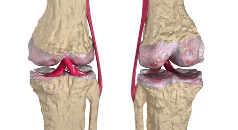 Overview of Three Common Bone Disorders - Osteoarthritis, Rheumatoid Arthritis and Osteoporosis ...