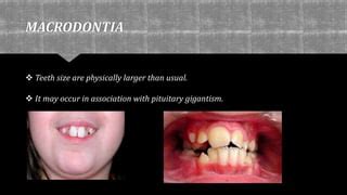 Abnormalities of teeth | PPT