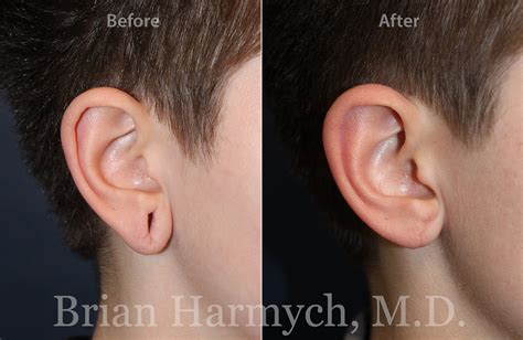 Earlobe Repair | Ear Surgery | Cleveland, OH