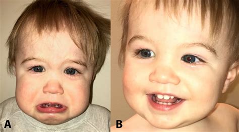 Congenital Nasolacrimal Duct Obstruction