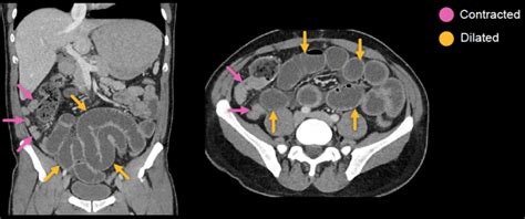 Abdominal CT: small intestine • LITFL • Radiology Library