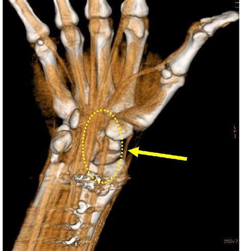 Extensor Pollicis Longus Anatomy