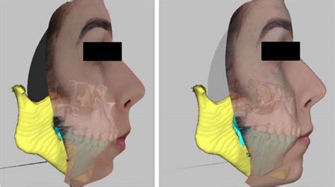 RBCP - The use of virtual planning in orthognathic surgery