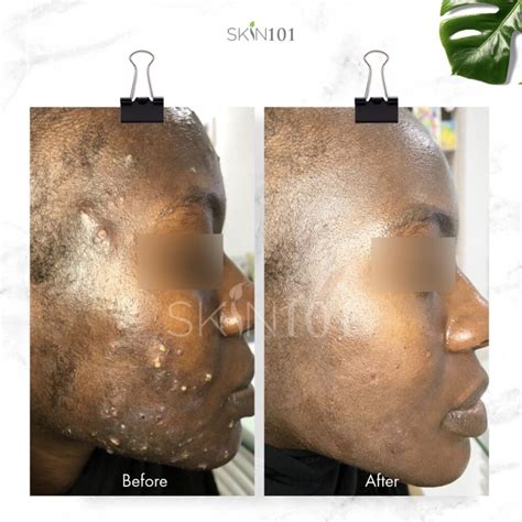 Severe Acne Treatment Before and After - Skin101 Center