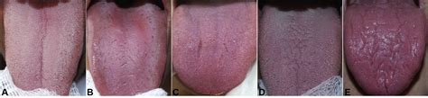 Fissured tongue in patients with psoriasis - Journal of the American ...