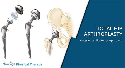 Total Hip Arthroplasty – Anterior vs. Posterior Approach - New Age ...