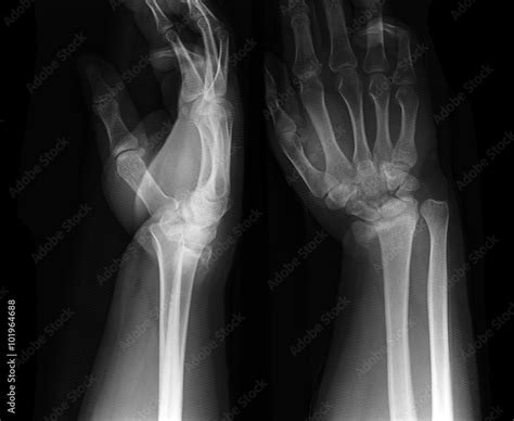 X-ray photos of hand bone fracture patients Stock Photo | Adobe Stock