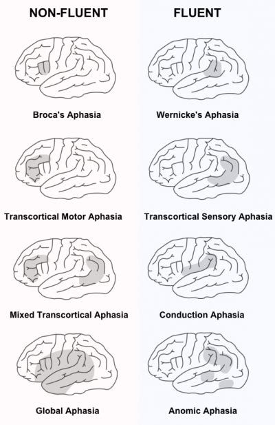 Transcortical Motor Aphasia Lesion Site | Webmotor.org