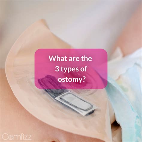 What are the 3 types of ostomy? – Comfizz