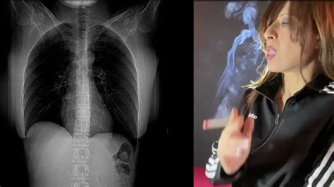 SandiSquirts 🇨🇦 on Twitter: "A Visual Guide to My Black Lungs Due to ...