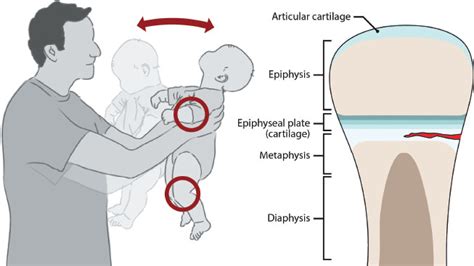 Bucket Handle Fracture