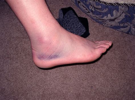 Swollen Ankles - Treatment, Pictures, Pregnancy, Symptoms, Causes