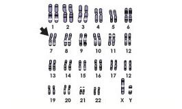 Cystic Fibrosis - Genetic Disorders and DNA Mutation