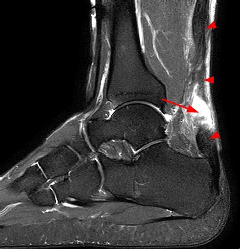 Achilles Tendon Xanthoma