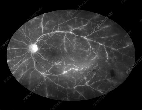 Retinal Vasculitis - Stock Image - C027/2256 - Science Photo Library